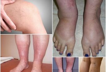 Photo of demonstrations of varicose veins on the legs