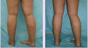 how varicose veins of the first stage manifest themselves