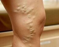 Varicose veins of the lower limbs during pregnancy