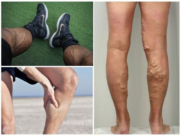 how varicose veins appear on men's legs