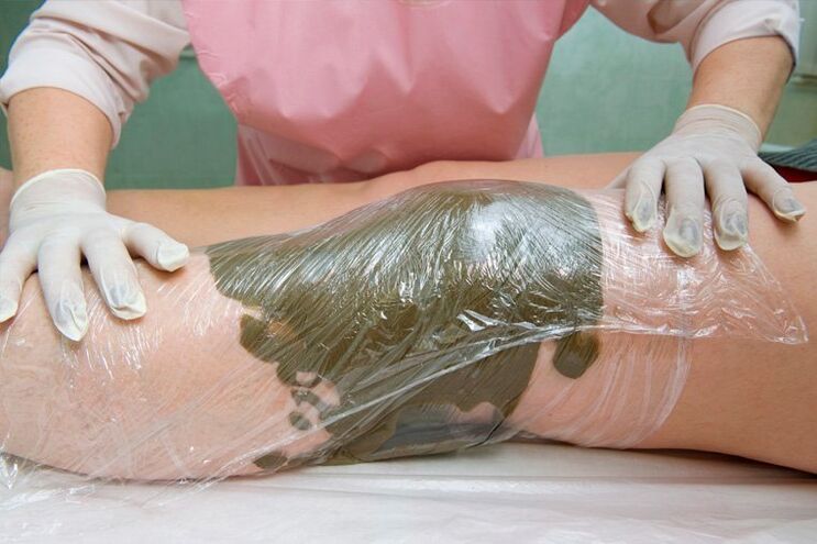 clay compresses against varicose veins