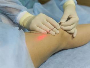 Treatment of varicose veins by laser