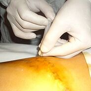Miniflebectomy is the most cosmetic treatment for varicose veins