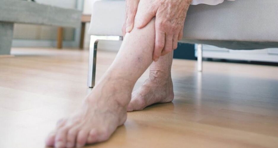 Varicose veins of the lower limbs caused by a malfunction of the venous valve
