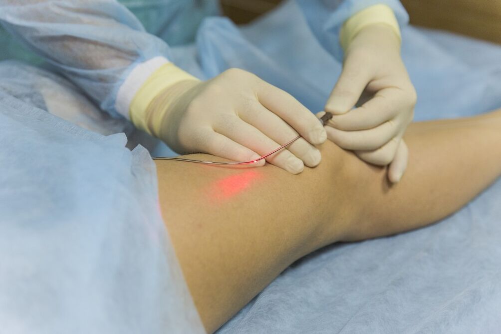 Laser treatment of varicose veins of the lower extremities