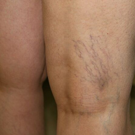 Venous network on the lower extremities is a sign of varicose veins