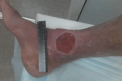 Complications of varicose veins