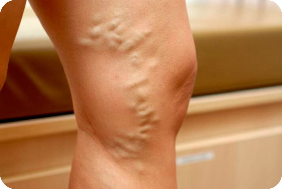 Varicose veins of the veins