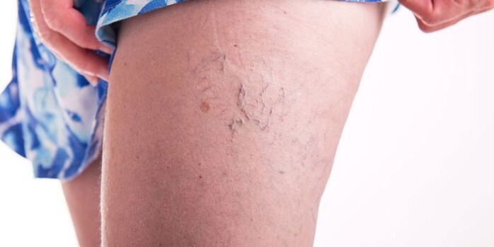 Prevention of varicose veins