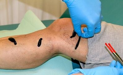 Hirudotherapy for varicose veins