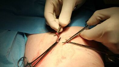 Flebectomy for varicose veins