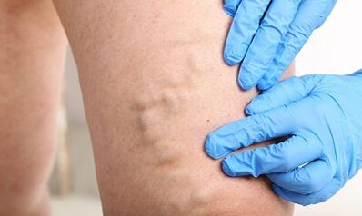 Varicose veins on the legs