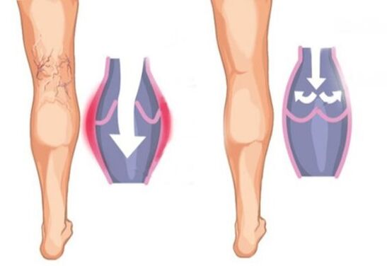 what are varicose veins like