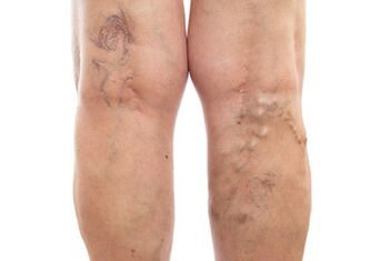 varicose veins of the lower limbs