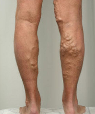 3 the phase of varicose veins